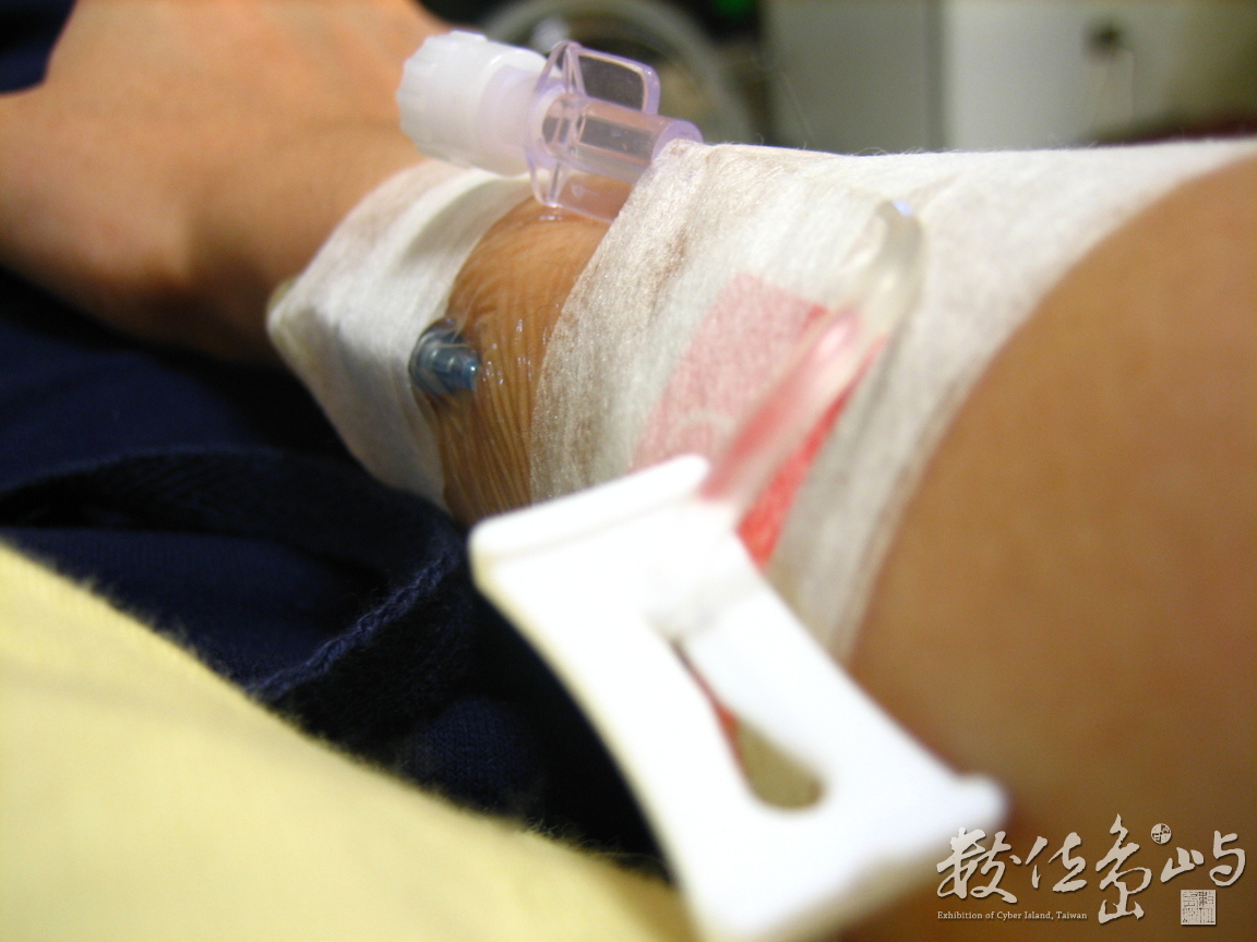 固定式針頭